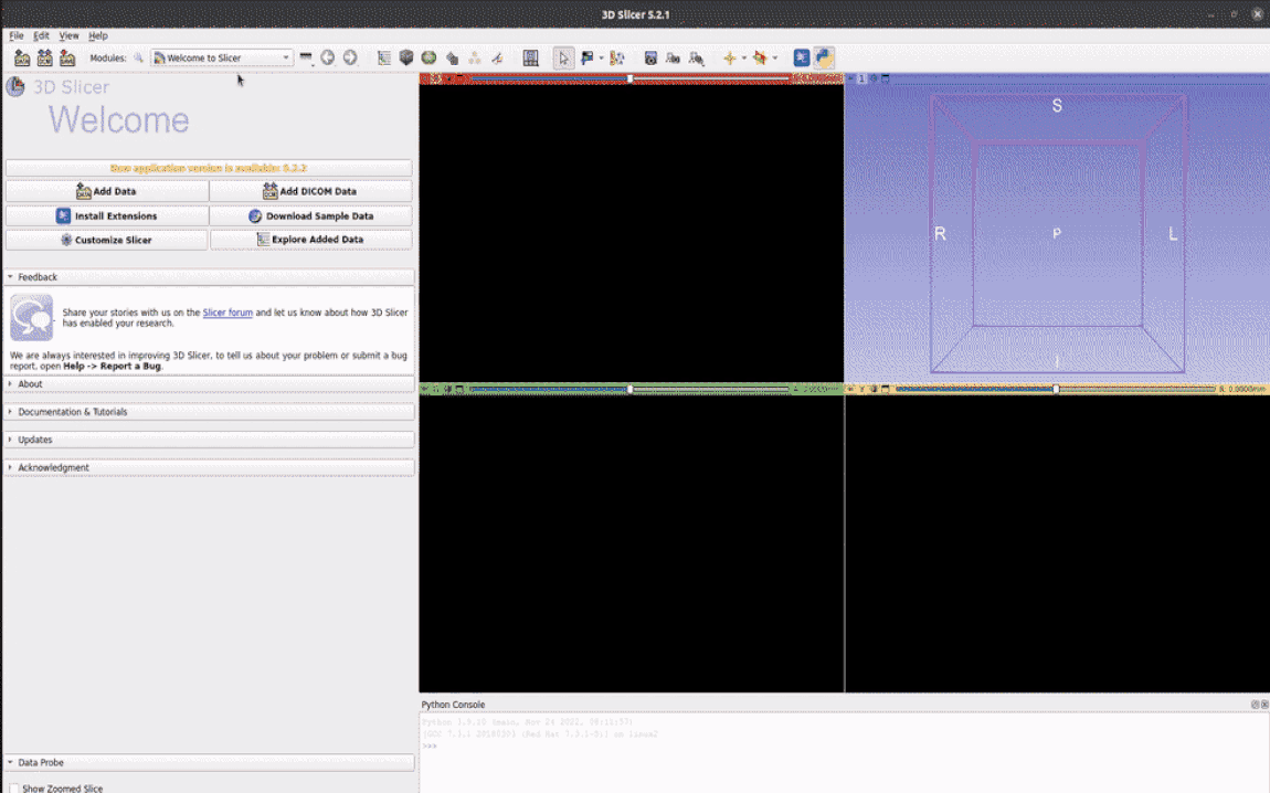Looping demo of the Raidionics plugin running inside 3D Slicer